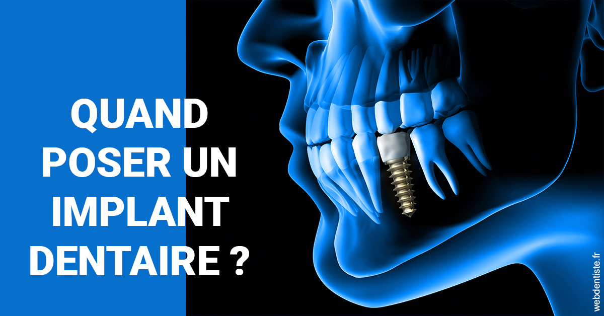 https://www.drfan.fr/Les implants 1
