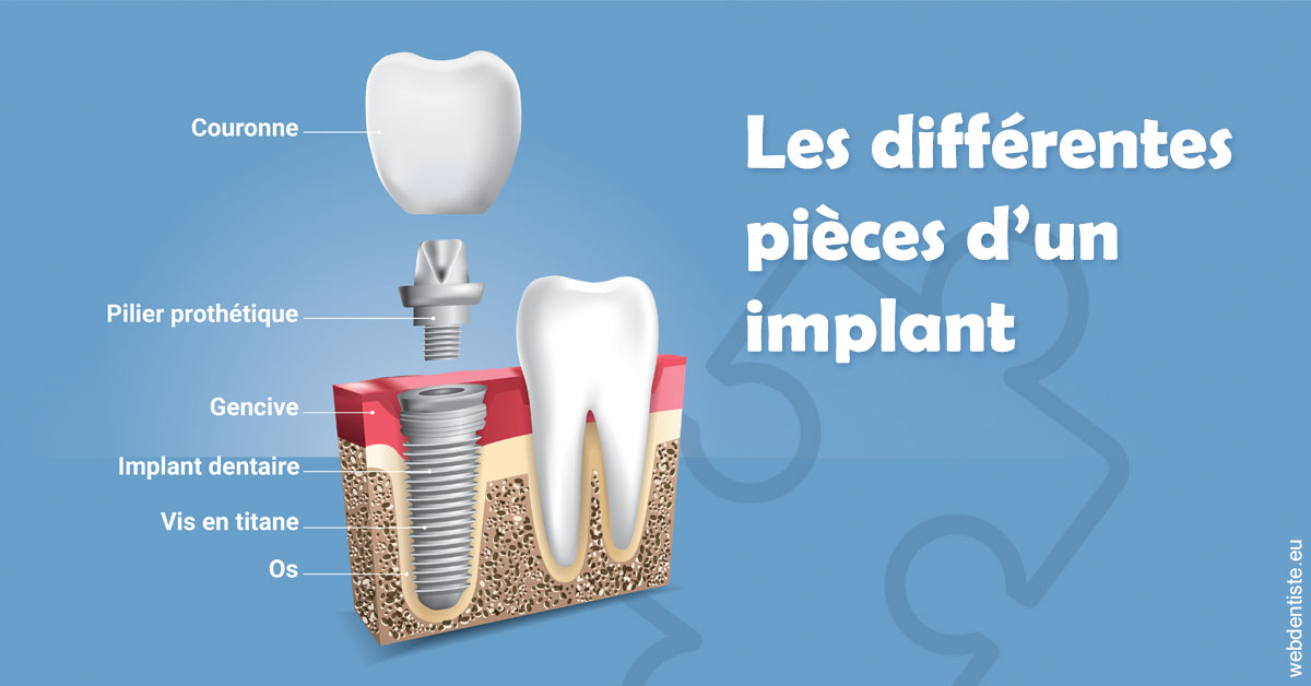 https://www.drfan.fr/Les différentes pièces d’un implant 1